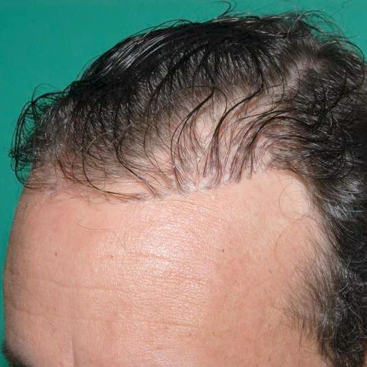 Patient before hair loss retreatment