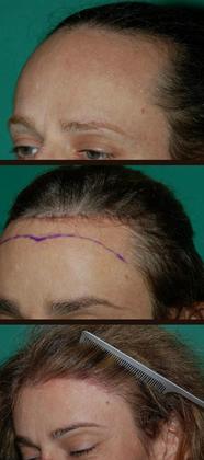 Stages of treatment, from side